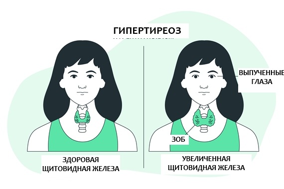 Гипертиреоз