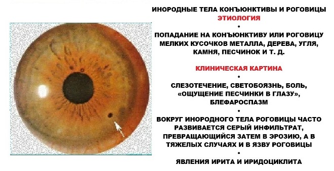 Инородное тело в глазу что делать 