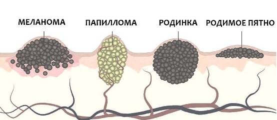 Причины появления папилломы на шее
