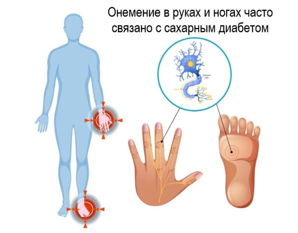 Сахарный диабет причина онемения конечностей