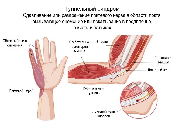 Туннельный синдром причина онемевших конечностей